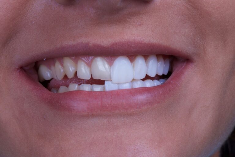 A Comprehensive Guide to Dental Veneers: Types, Benefits, and Considerations
