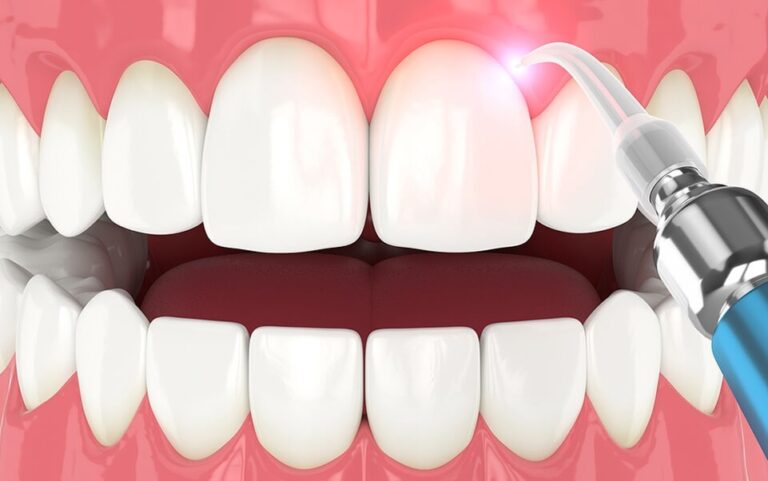The Benefits Of Laser Therapy In Periodontal Treatment