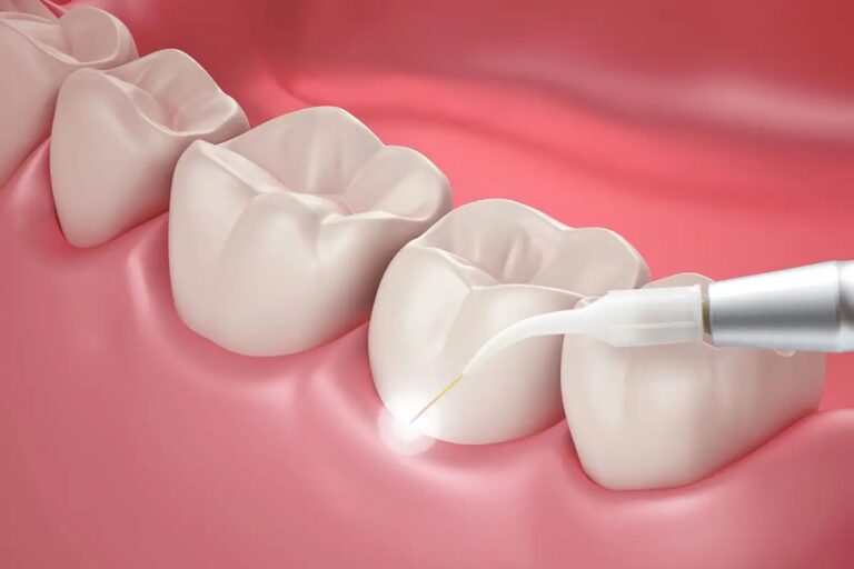 The Benefits Of Laser Therapy In Periodontal Treatment